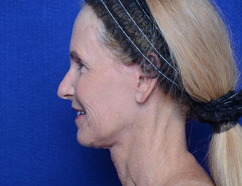 Facelift Before & After