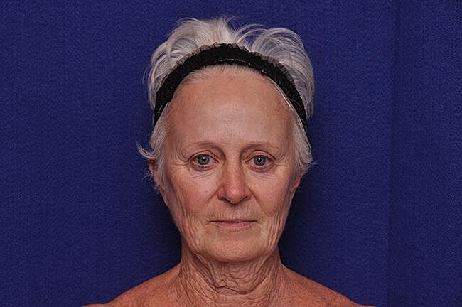 Facelift Before & After