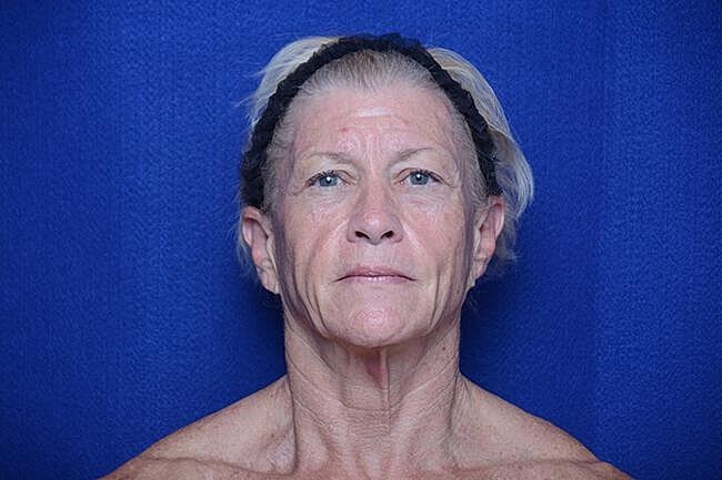 Facelift Before & After