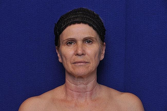 Facelift Before & After