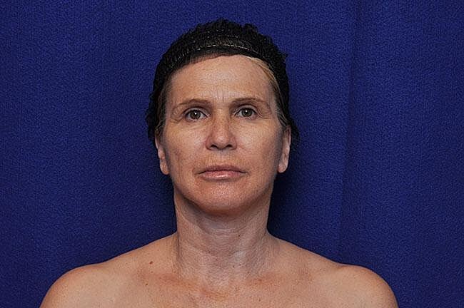 Facelift Before & After