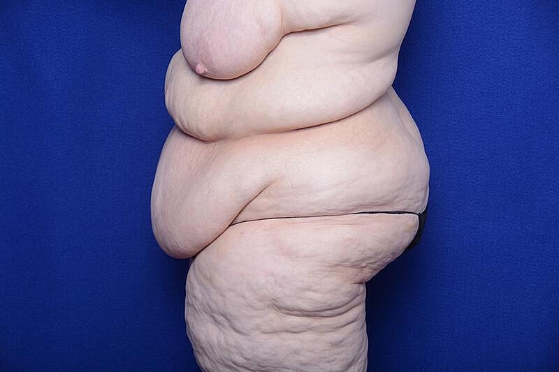 After Massive Weight Loss Surgery Before & After