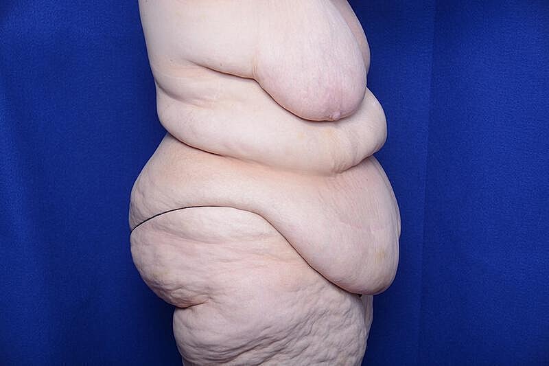 After Massive Weight Loss Surgery Before & After