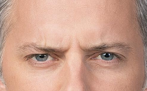 Botox Men Before & After