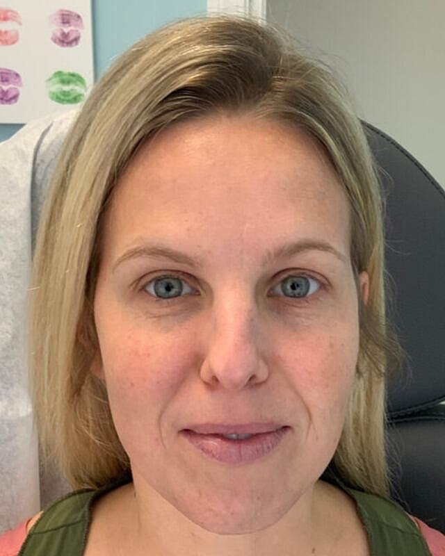 Injectables Before & After