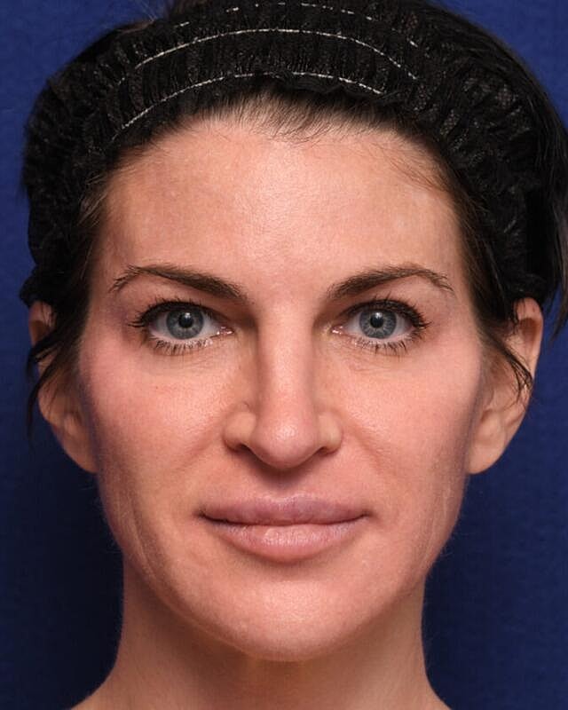 Injectables Before & After