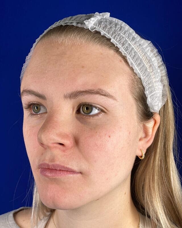 Injectables Before & After