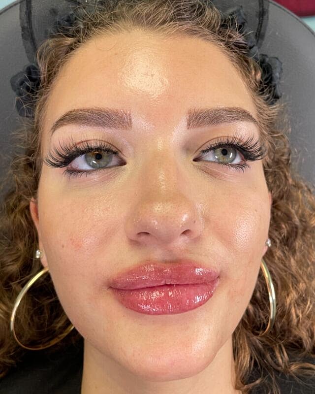 Injectables Before & After