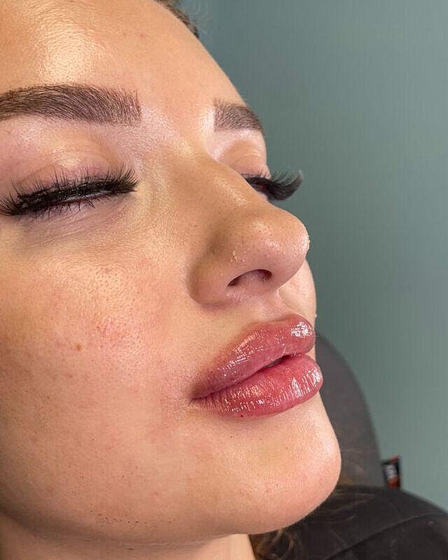 Injectables Before & After