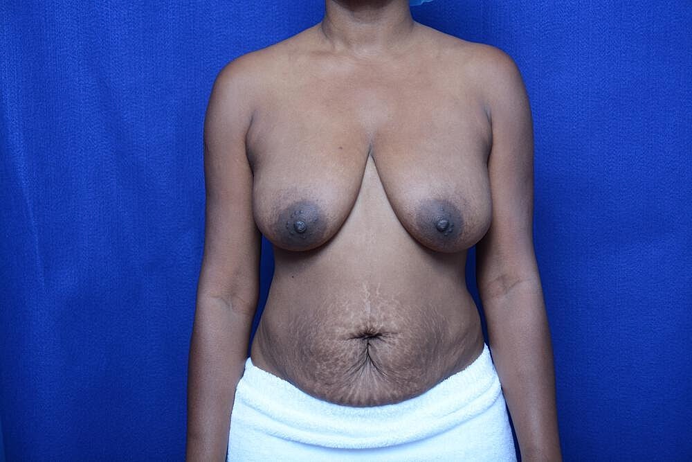 Mommy Makeover Before & After