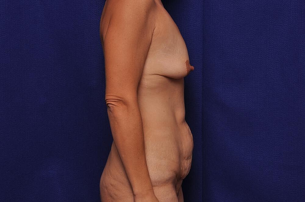 Mommy Makeover Before & After