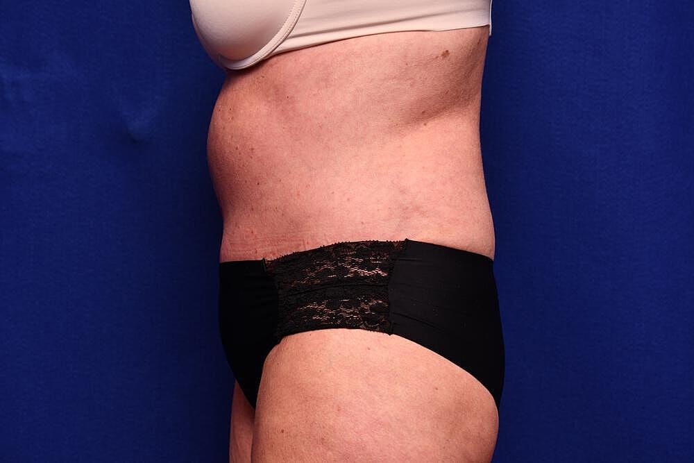 Tummy Tuck Before & After
