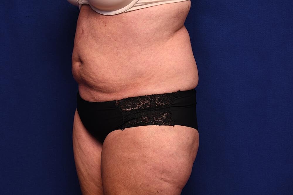 Tummy Tuck Before & After