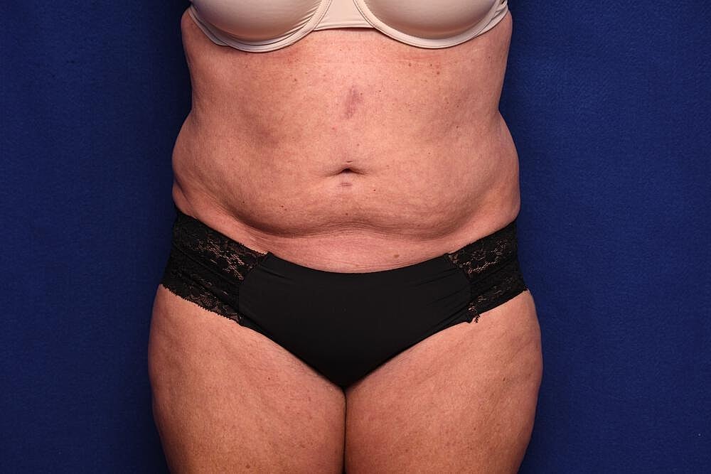 Tummy Tuck Before & After