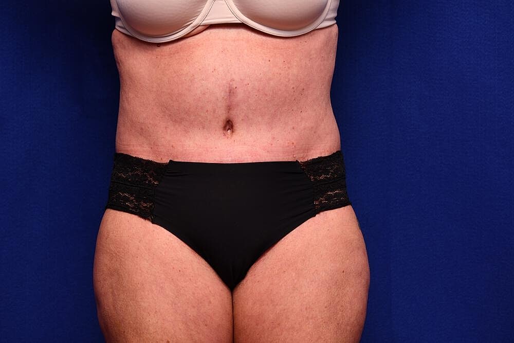 Tummy Tuck Before & After