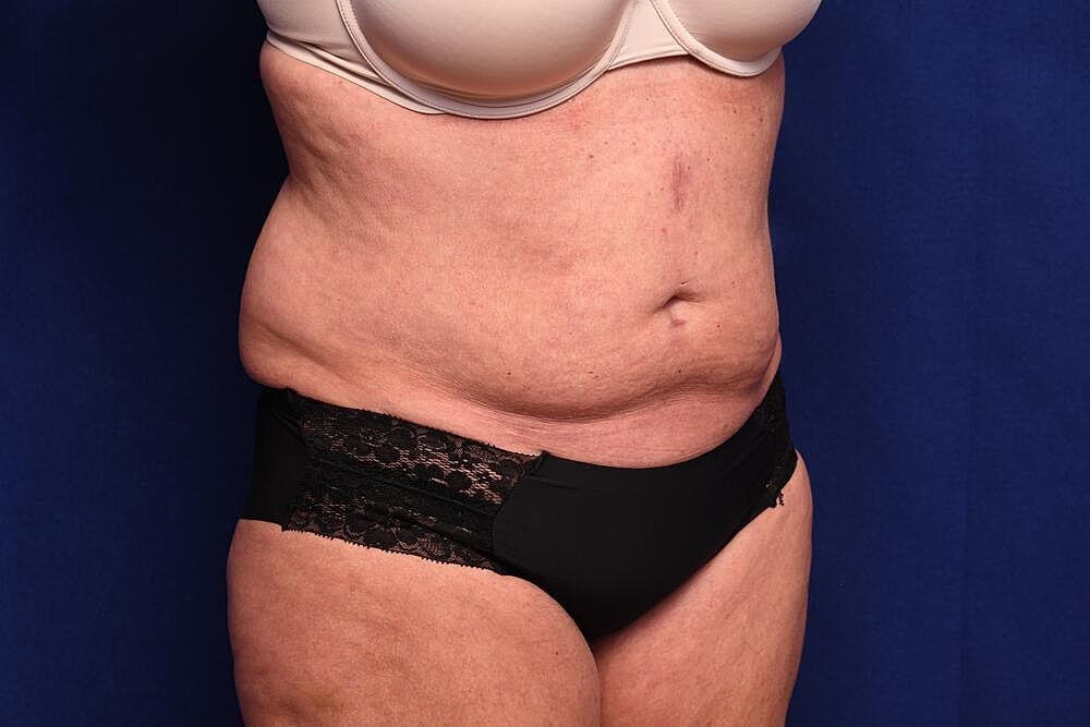 Tummy Tuck Before & After