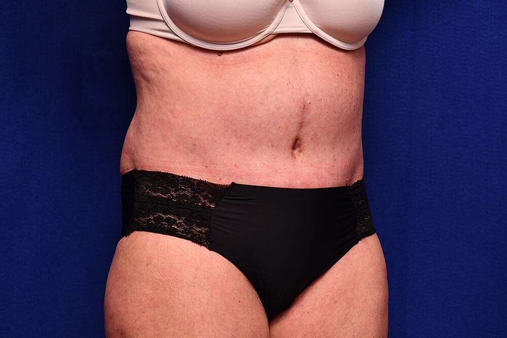 Tummy Tuck Before & After