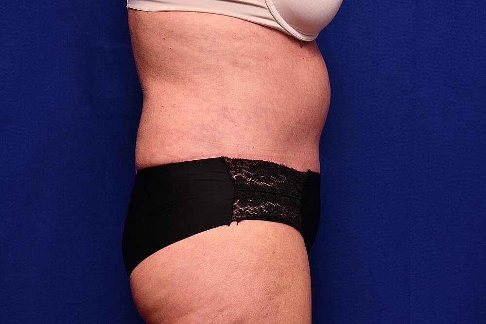 Tummy Tuck Before & After