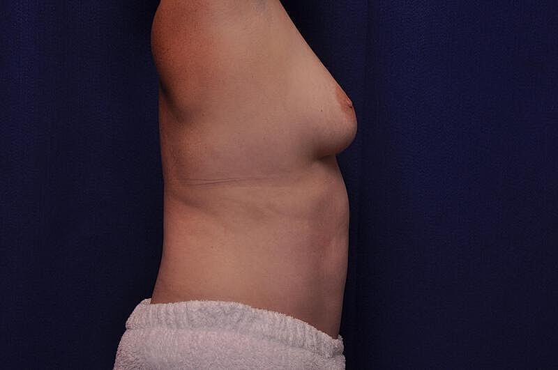 Tummy Tuck Before & After