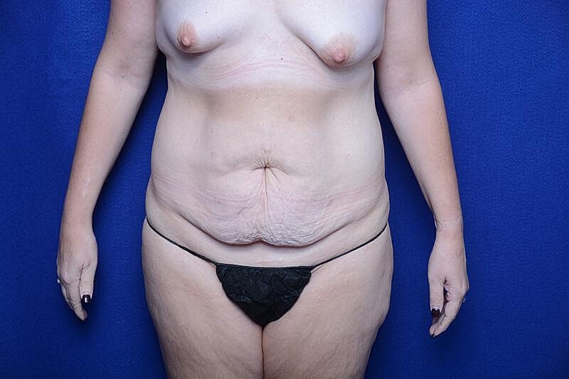 Tummy Tuck Before & After