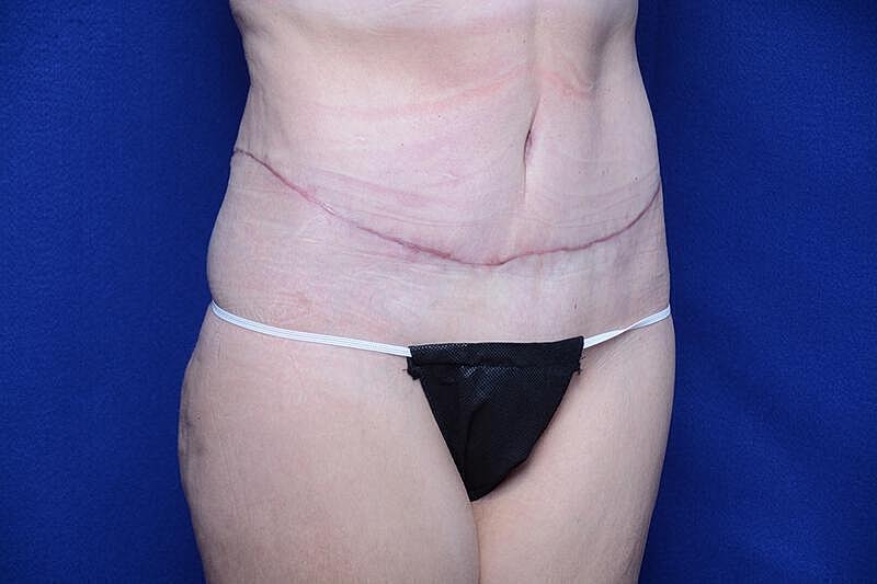 Tummy Tuck Before & After