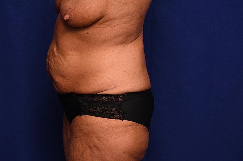 Tummy Tuck Before & After