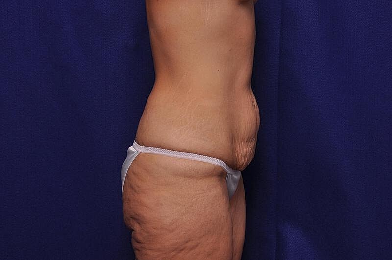 Tummy Tuck Before & After