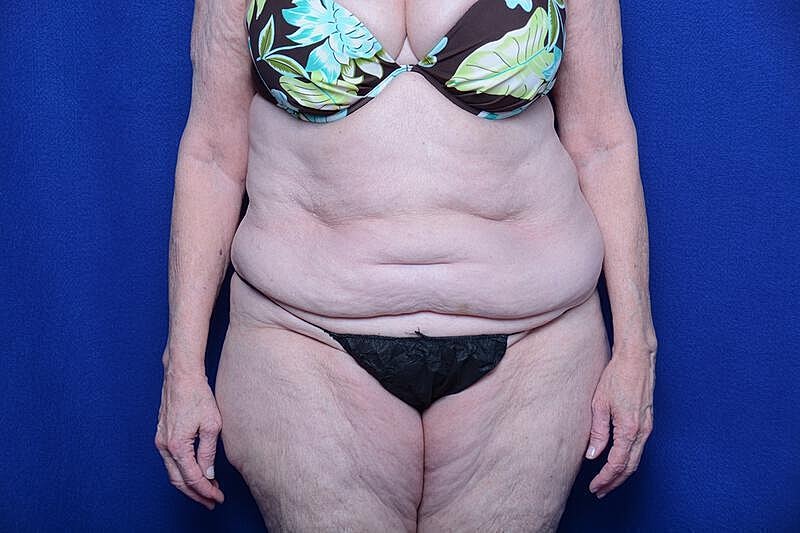 Tummy Tuck Before & After