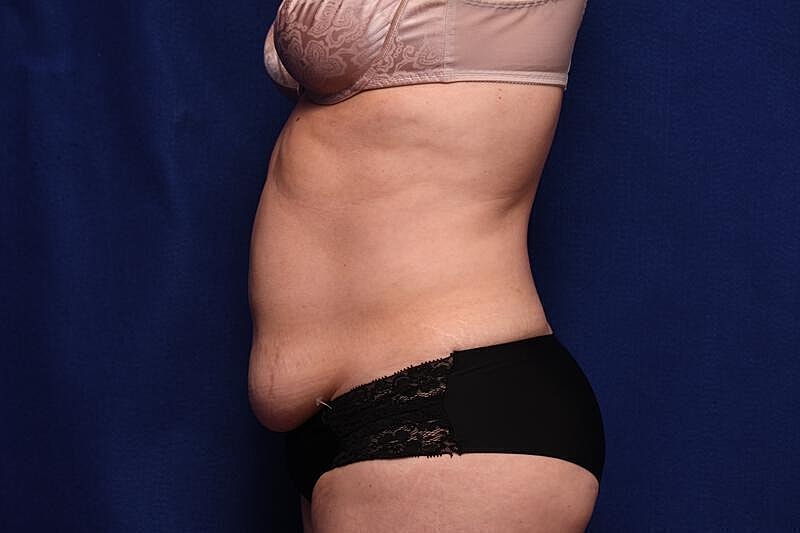 Tummy Tuck Before & After