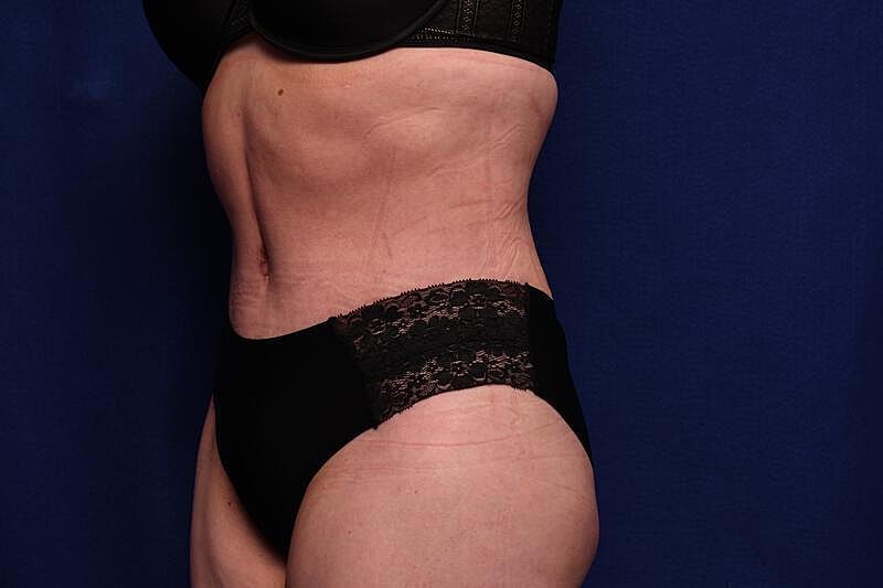 Tummy Tuck Before & After