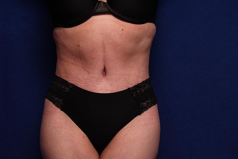 Tummy Tuck Before & After