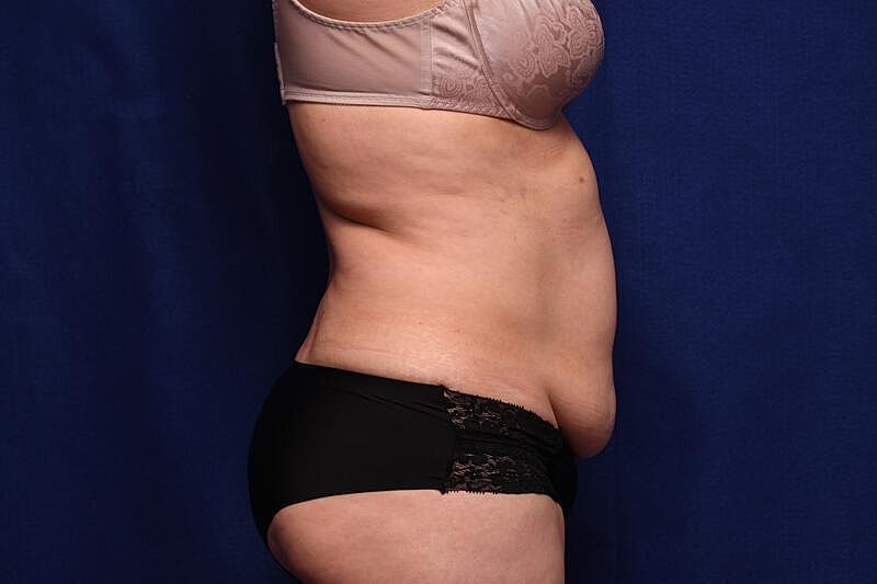 Tummy Tuck Before & After
