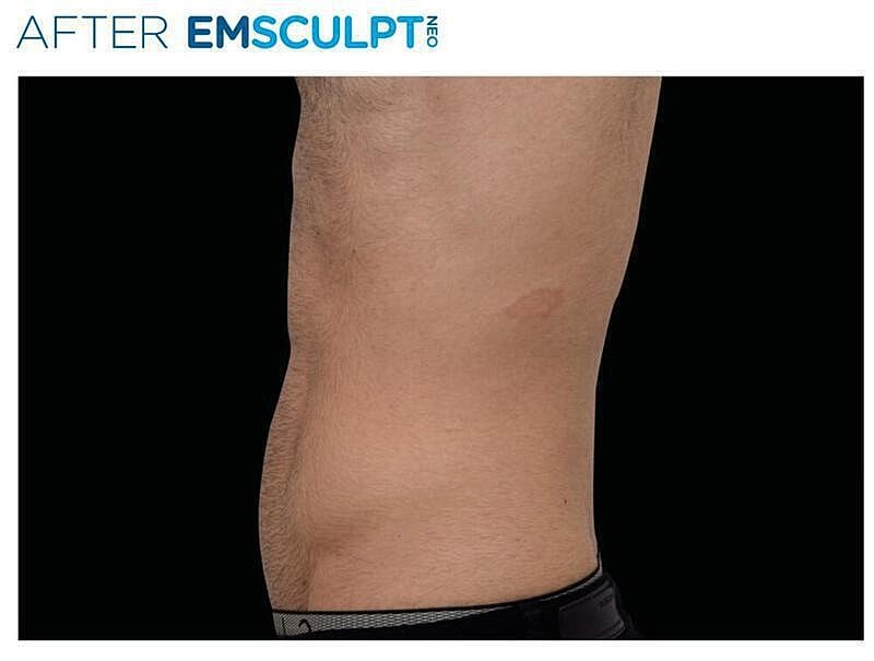 Emsculpt Abdomen Before & After