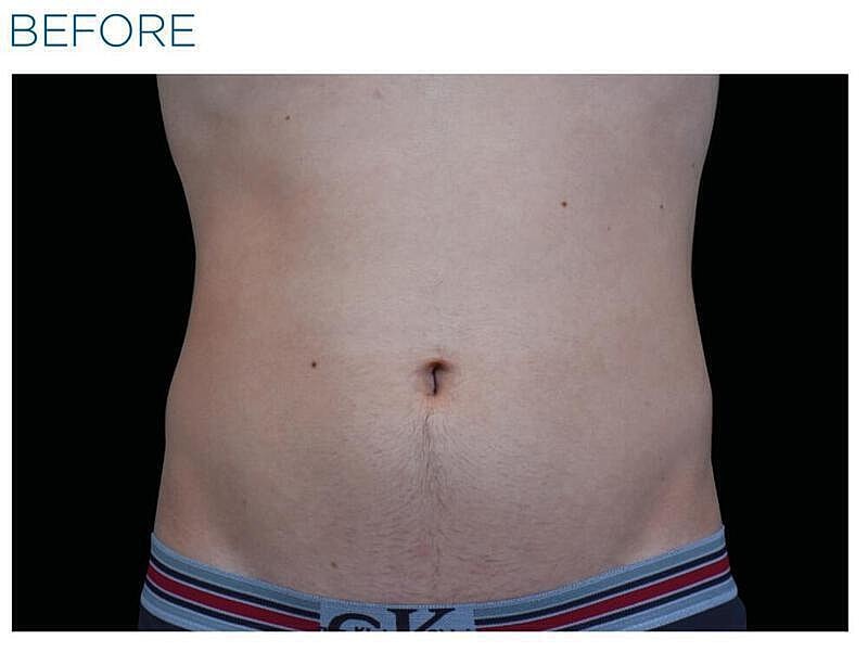 Emsculpt Abdomen Before & After