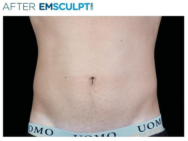 Emsculpt Abdomen Before & After