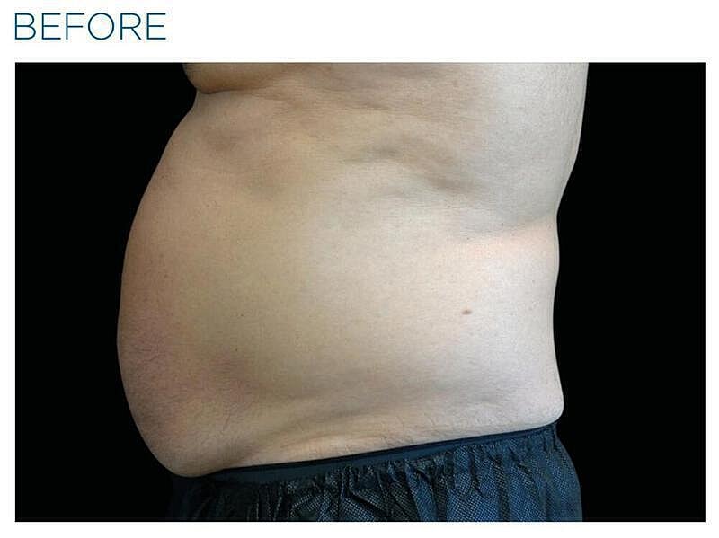 Emsculpt Abdomen Before & After