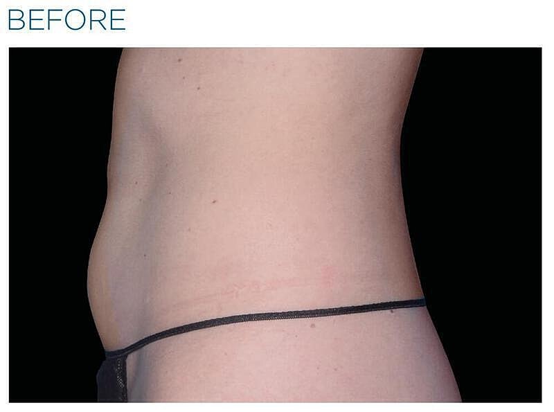 Emsculpt Abdomen Before & After