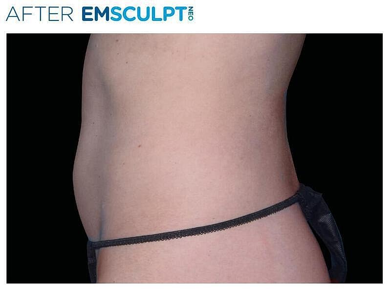 Emsculpt Abdomen Before & After