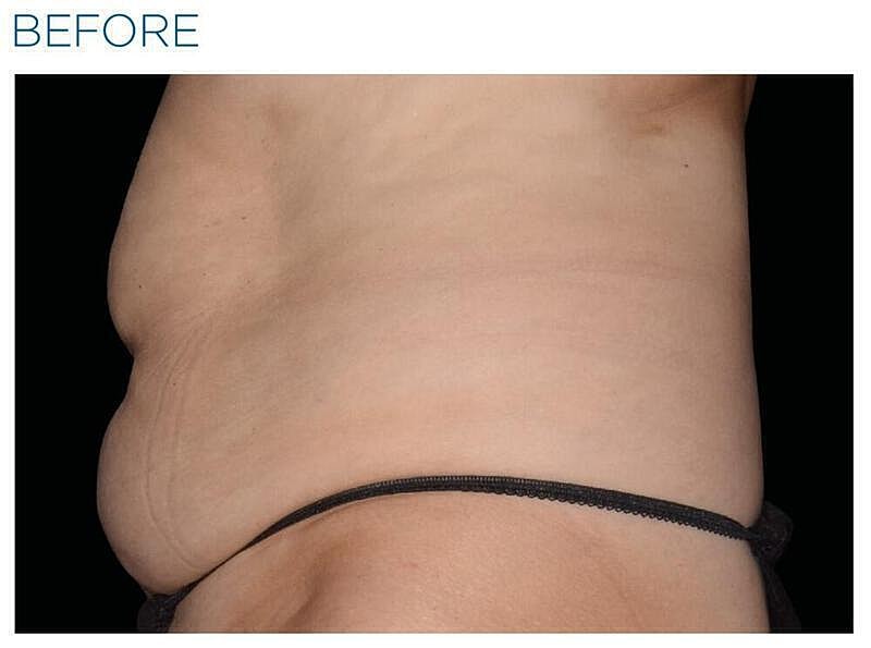 Emsculpt Abdomen Before & After