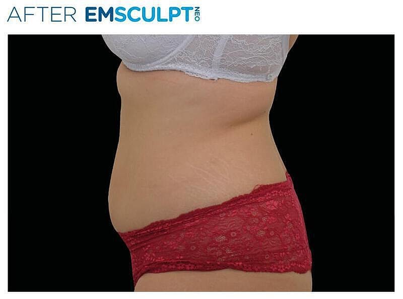 Emsculpt Abdomen Before & After