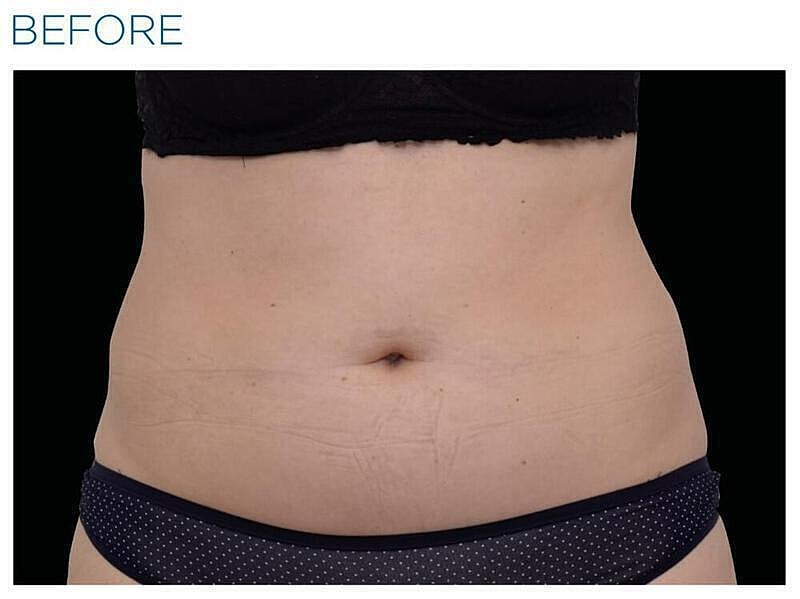 Emsculpt Abdomen Before & After