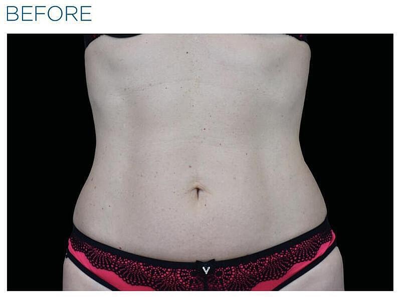 Emsculpt Abdomen Before & After