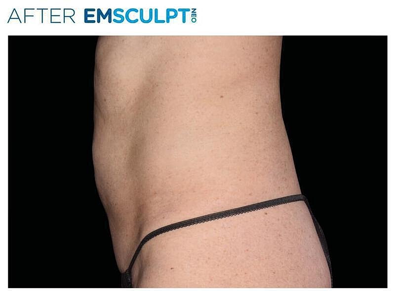 Emsculpt Abdomen Before & After