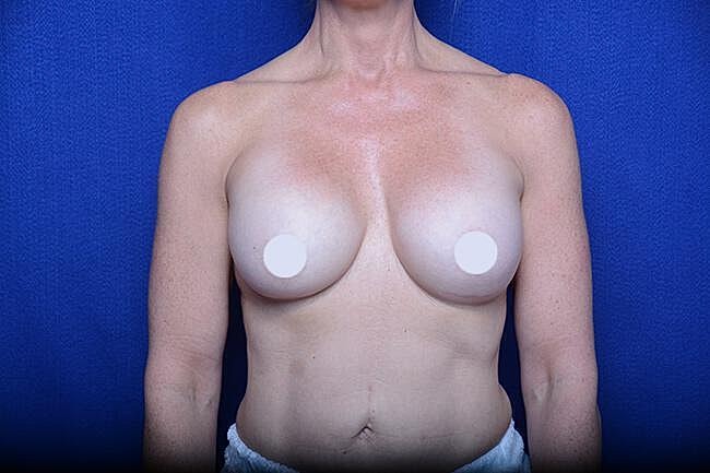 Athletic Breast Augmentation Revision Before & After
