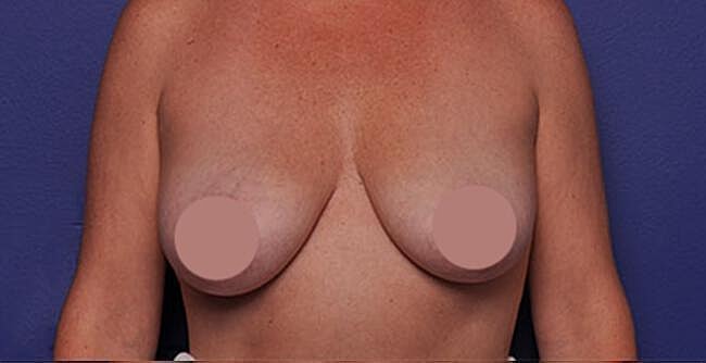 Breast Augmentation Before & After