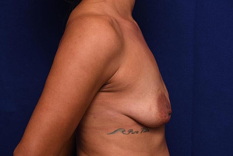 Breast Augmentation Before & After