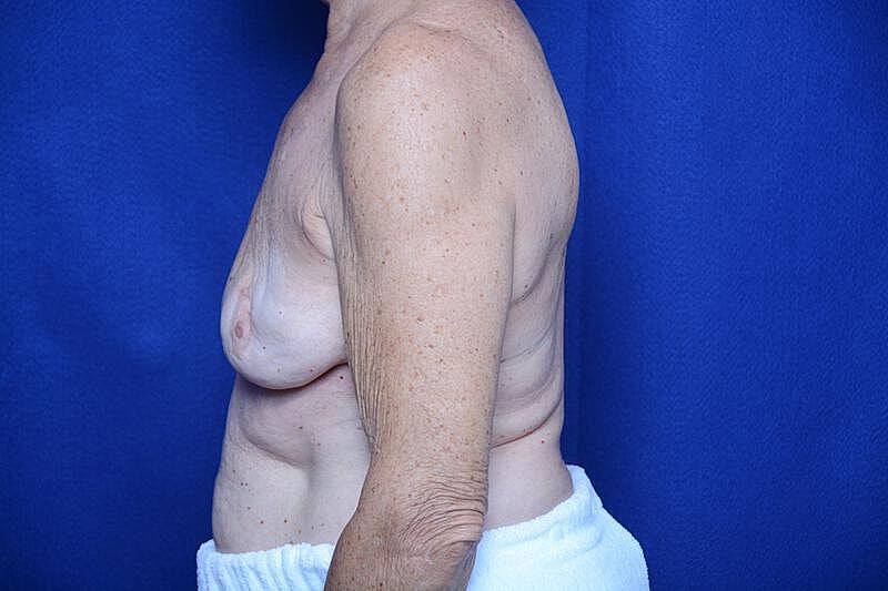 Breast Augmentation Before & After