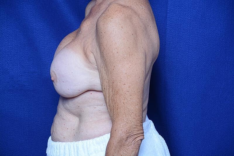 Breast Augmentation Before & After