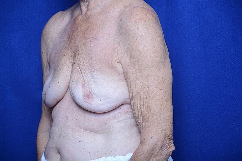 Breast Augmentation Before & After