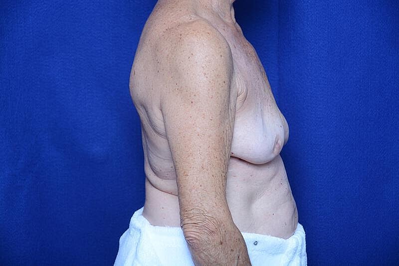 Breast Augmentation Before & After